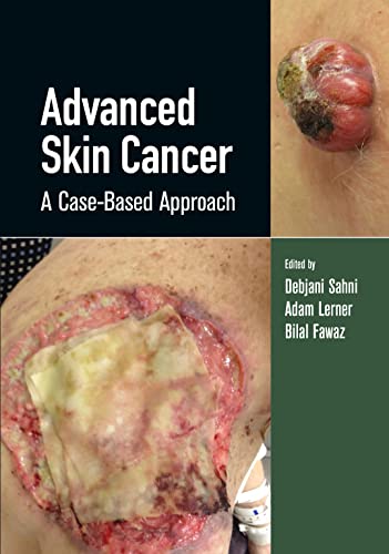 Complex Skin Cancer - Debjani Sahni