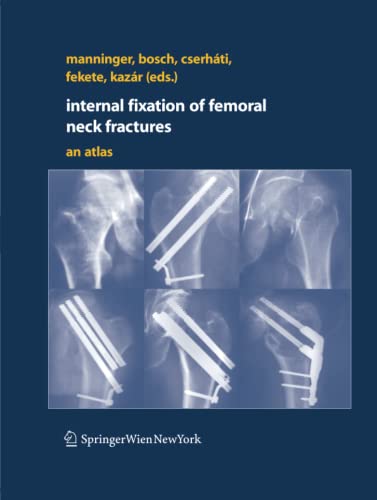 Internal fixation of femoral neck fractures - Jenó Manninger