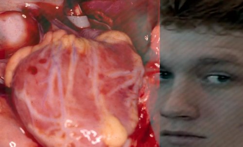 A Life for a Life: Trading Organs for One More Today (2015)
